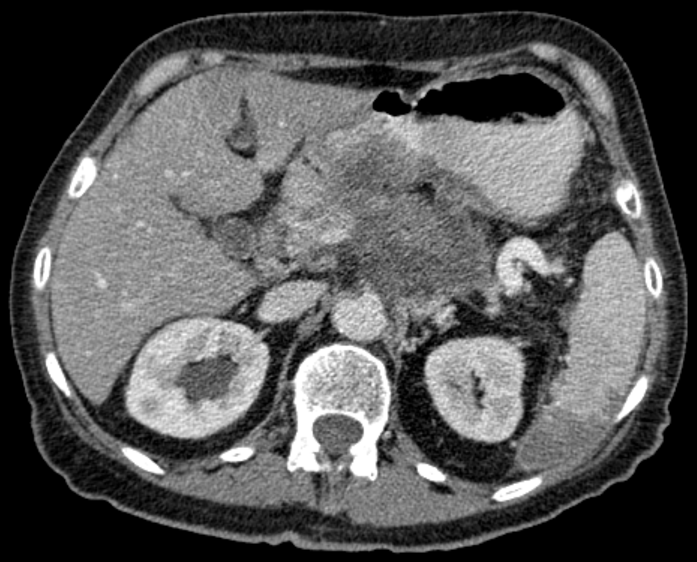 CT scan of the abdomen showing Pancreatic Cancer tumor near the Celiac Plexus which was later treated by nerve blockade.