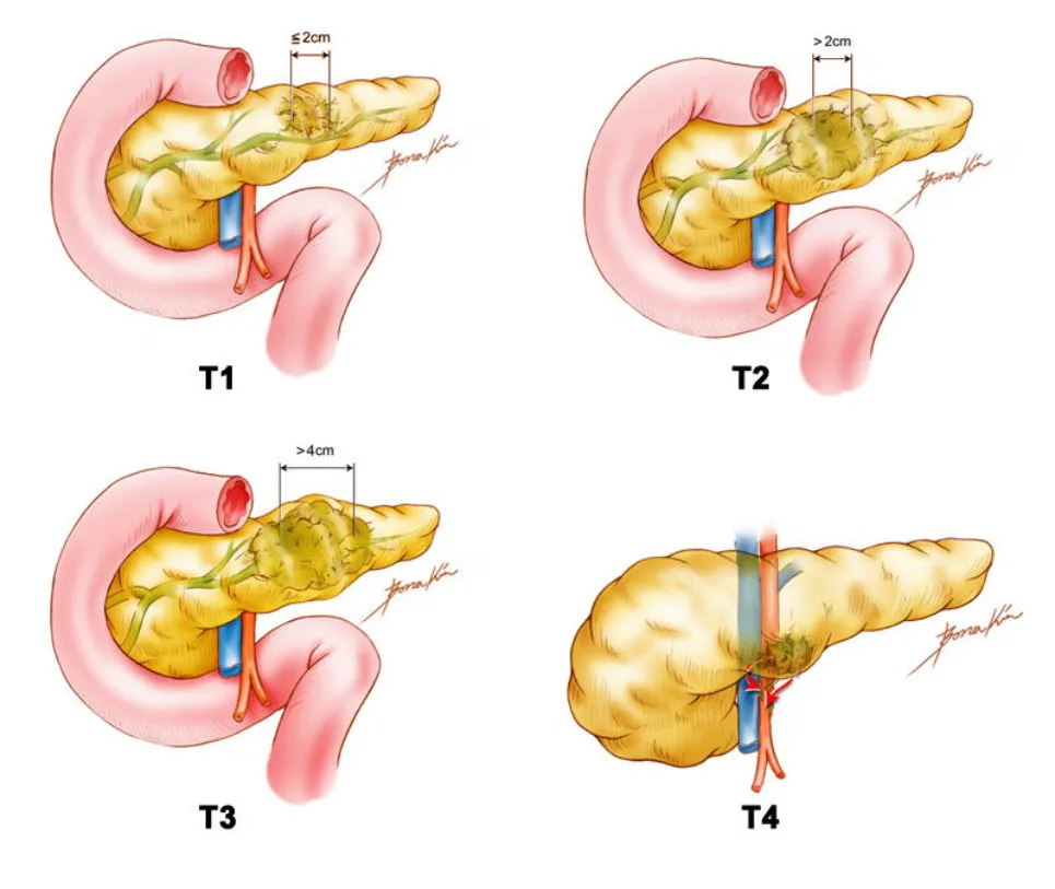 Illustration of staging of pancreatic cancer, TMN stages T1 to T4.