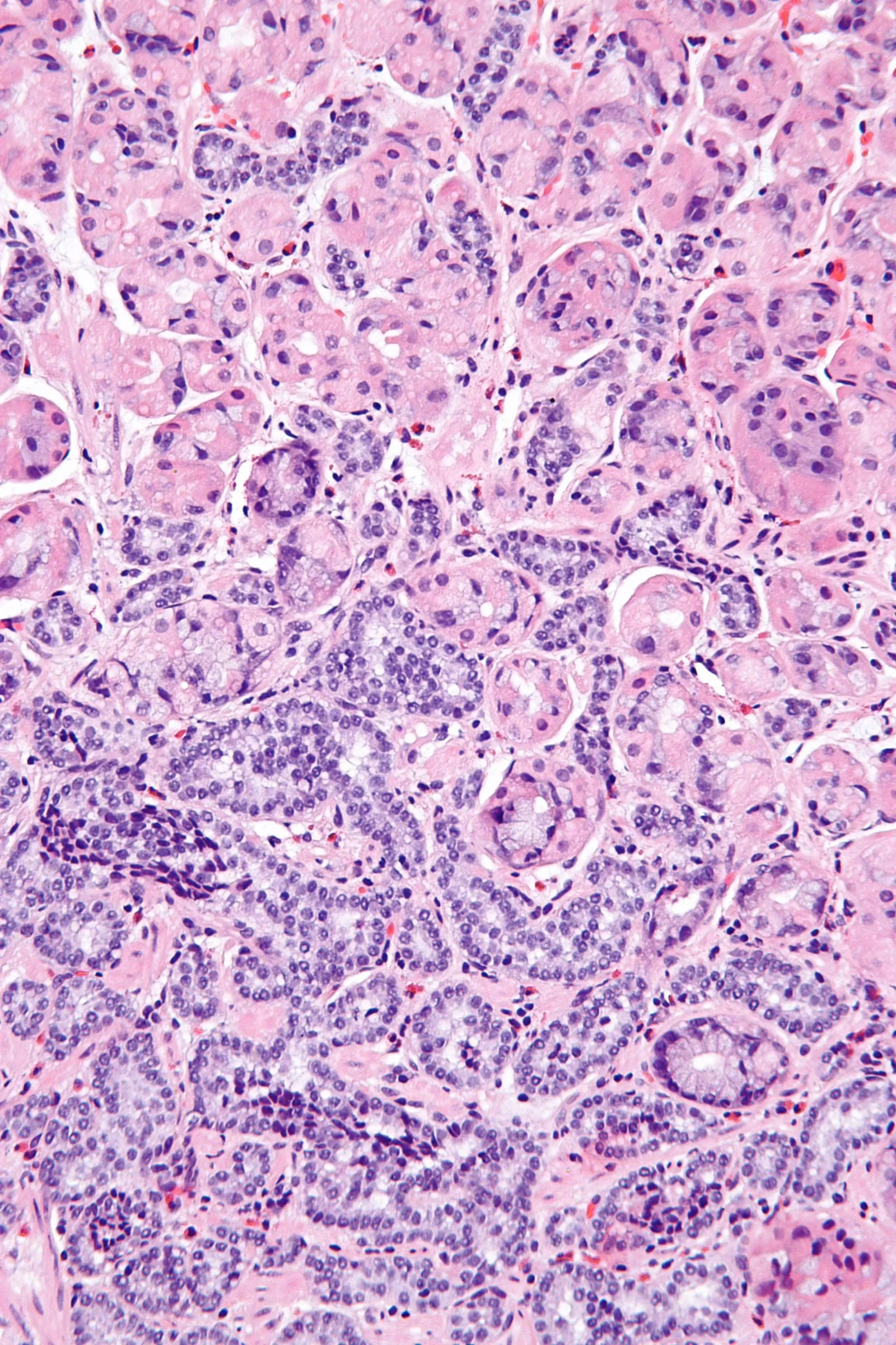 High magnification micrograph of a gastric neuroendocrine tumor (NET), showing clustered cells. (Credit: Dr. Maria Tsoumbou)