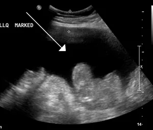 Medical imaging showing ascites: fluid buildup in abdominal cavity, common in pancreatic cancer patients